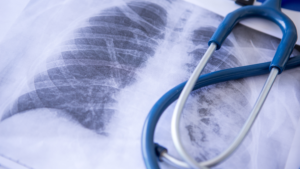 Read more about the article Having Lung Disease Increases Your Risk of Severe Illness From COVID-19